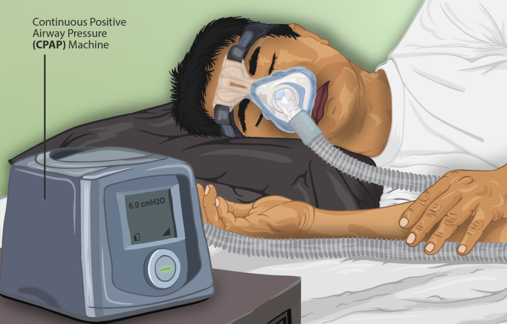 স্লিপ অ্যাপনিয়া (Sleep Apnea) বা নিদ্রাকালীন শ্বাসব্যাঘাত এর কারণ, উপসর্গ, জটিলতা ও চিকিৎসা