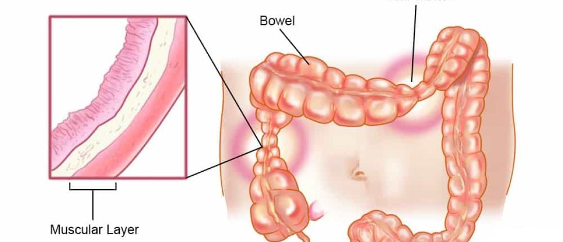 IBS
