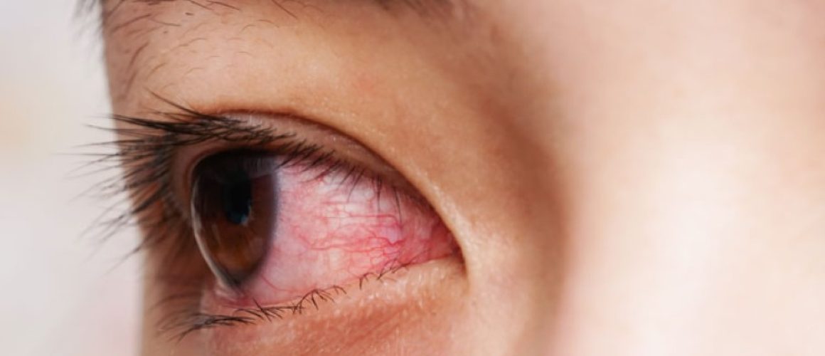 কনজাংটিভাইটিস (conjunctivitis)