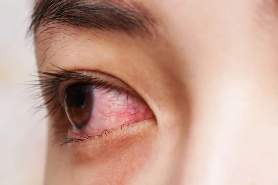 কনজাংটিভাইটিস(conjunctivitis) বা চোখ ওঠার কারণ, উপসর্গ, জটিলতা ও চিকিৎসা