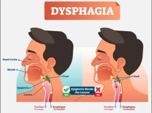 ডিসফেজিয়া(Dysphagia) বা গলায় খাবার আটকানো সমস্যা এর কারণ, উপসর্গ, জটিলতা ও চিকিৎসা