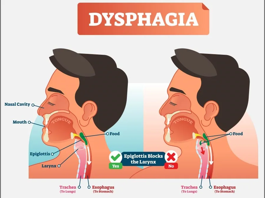 ডিসফেজিয়া(Dysphagia) বা গলায় খাবার আটকানো সমস্যা এর কারণ, উপসর্গ, জটিলতা ও চিকিৎসা