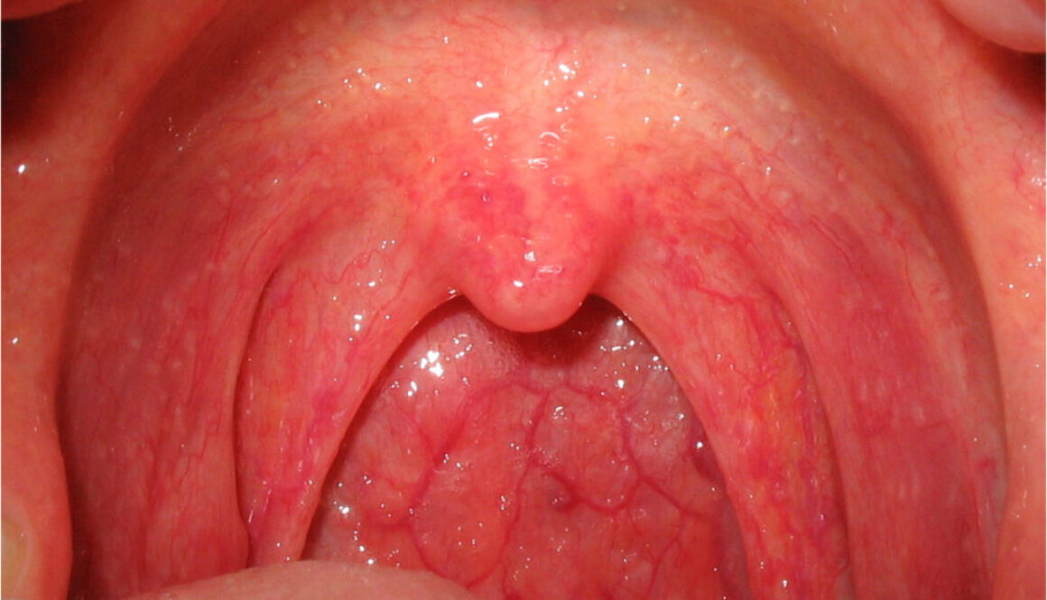 ফ্যারিঞ্জাইটিস(Pharyngitis) বা গলবিল প্রদাহ এর কারণ, উপসর্গ, জটিলতা ও চিকিৎসা