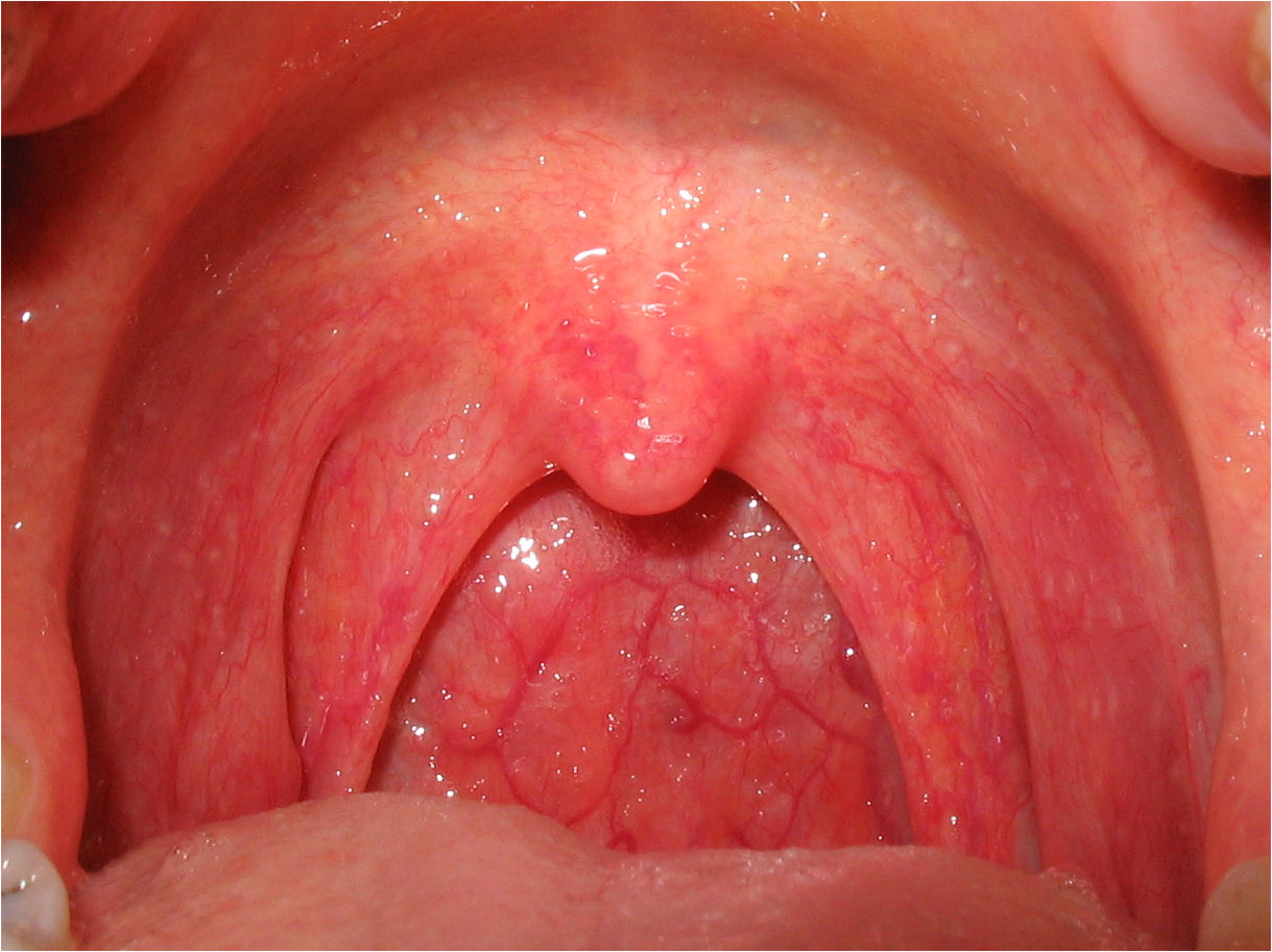 Virus papiloma en garganta sintomas