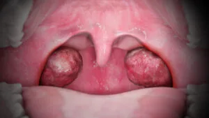 টনসিলাইটিস(Tonsillitis) বা টনসিলের প্রদাহ এর কারণ, উপসর্গ, জটিলতা ও চিকিৎসা