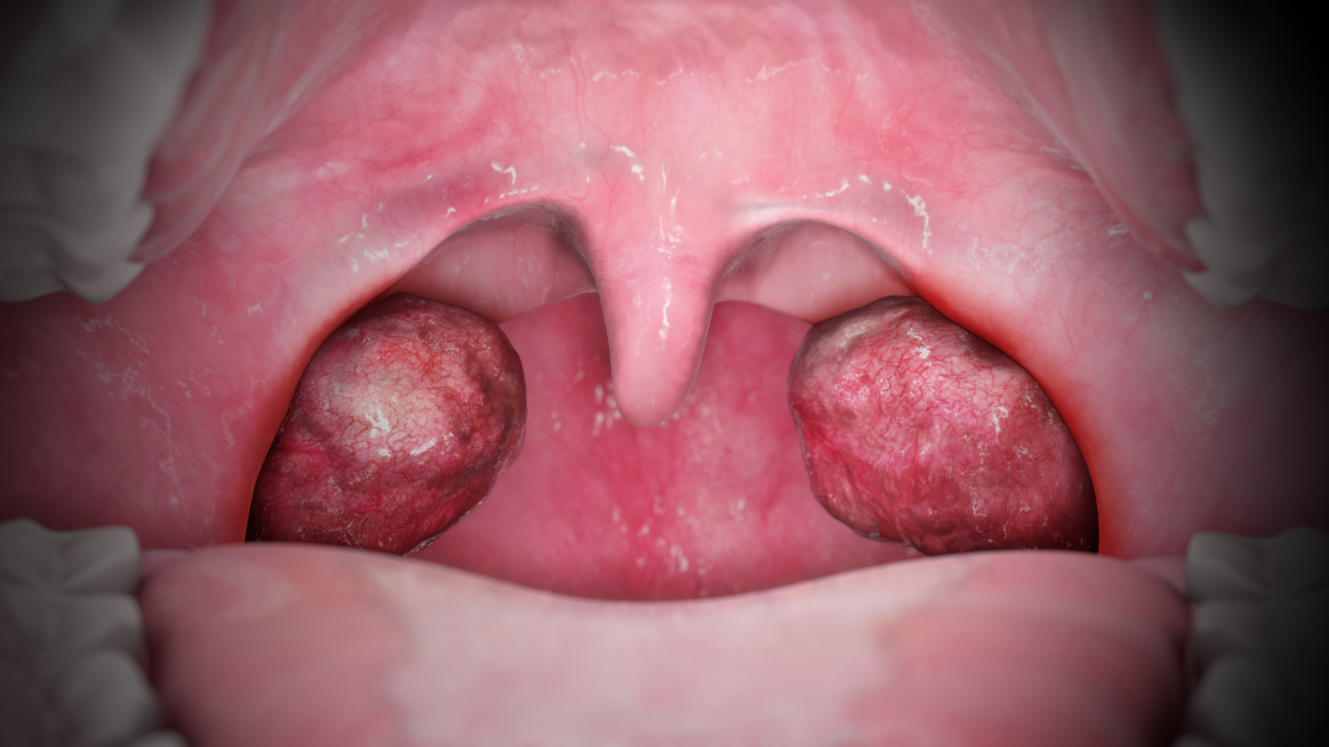 টনসিলাইটিস(Tonsillitis) বা টনসিলের প্রদাহ এর কারণ, উপসর্গ, জটিলতা ও চিকিৎসা