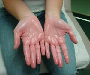 অত্যাধিক ঘামা (Excessive Sweating or Sweating Profusely) বা হাইপারহাইড্রোসিস(Hyperhidrosis) এর কারণ, উপসর্গ, জটিলতা ও চিকিৎসা