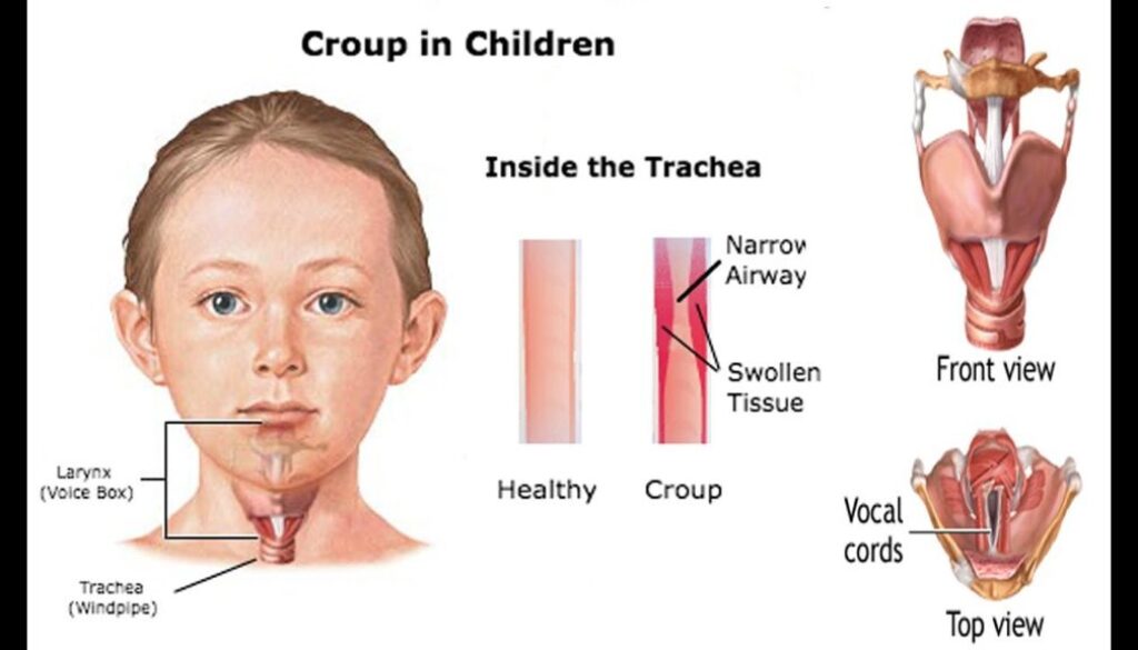 খুংরিকাশি (Croup) বা ল্যারিঞ্জোট্র্যাকিওব্রঙ্কাইটিস (Laryngotracheobronchitis) এর কারণ, উপসর্গ, জটিলতা ও চিকিৎসা