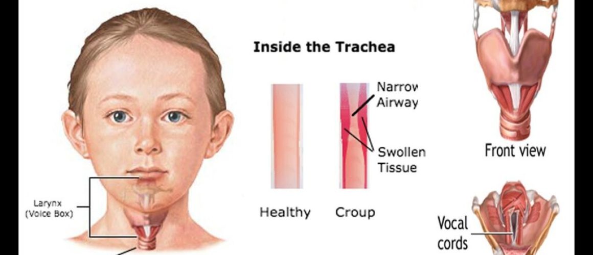 খুংরিকাশি (Croup) বা ল্যারিঞ্জোট্র্যাকিওব্রঙ্কাইটিস (Laryngotracheobronchitis) এর কারণ, উপসর্গ, জটিলতা ও চিকিৎসা