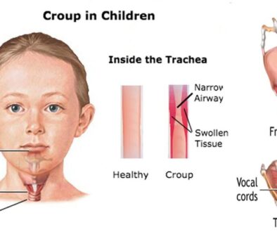 খুংরিকাশি (Croup) বা ল্যারিঞ্জোট্র্যাকিওব্রঙ্কাইটিস (Laryngotracheobronchitis) এর কারণ, উপসর্গ, জটিলতা ও চিকিৎসা