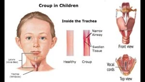 খুংরিকাশি (Croup) বা ল্যারিঞ্জোট্র্যাকিওব্রঙ্কাইটিস (Laryngotracheobronchitis) এর কারণ, উপসর্গ, জটিলতা ও চিকিৎসা
