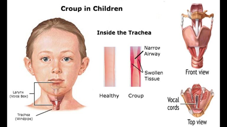 খুংরিকাশি (Croup) বা ল্যারিঞ্জোট্র্যাকিওব্রঙ্কাইটিস (Laryngotracheobronchitis) এর কারণ, উপসর্গ, জটিলতা ও চিকিৎসা