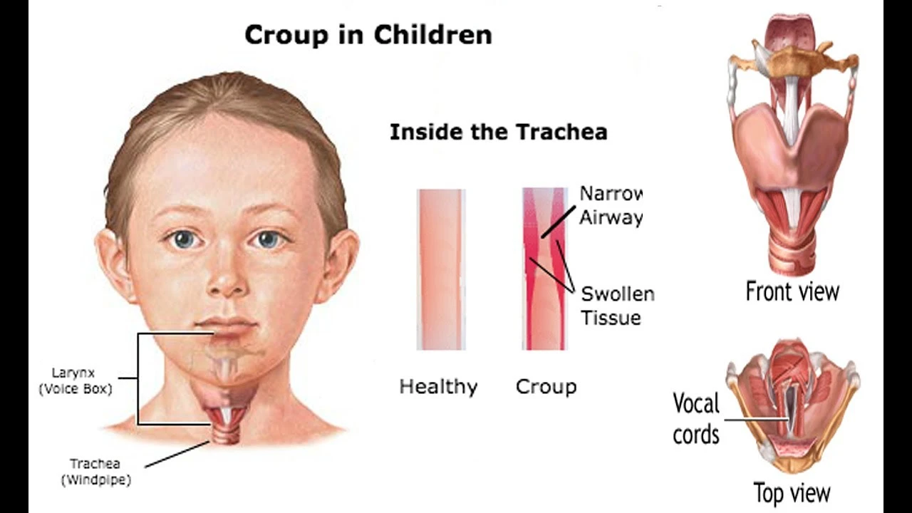 খুংরিকাশি (Croup) বা ল্যারিঞ্জোট্র্যাকিওব্রঙ্কাইটিস (Laryngotracheobronchitis) এর কারণ, উপসর্গ, জটিলতা ও চিকিৎসা