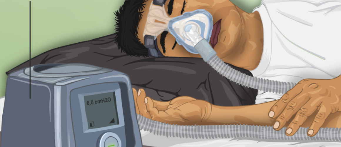 স্লিপ অ্যাপনিয়া (Sleep Apnea) বা নিদ্রাকালীন শ্বাসব্যাঘাত এর কারণ, উপসর্গ, জটিলতা ও চিকিৎসা